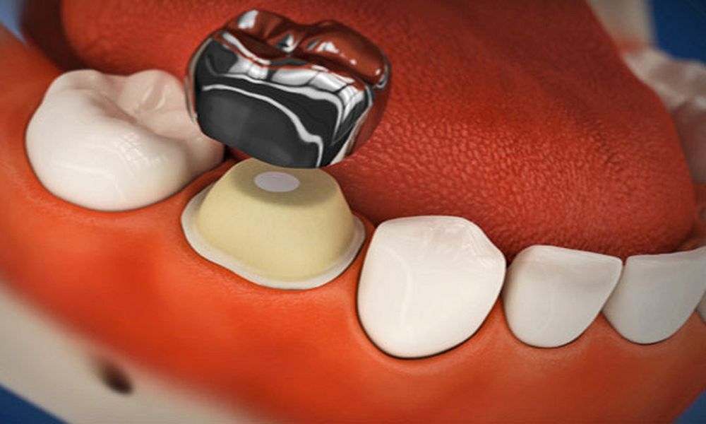 Стоматология Dominanta г. Краснодар Фиксация одной коронки Dental CLinic ул. Чапаева 77