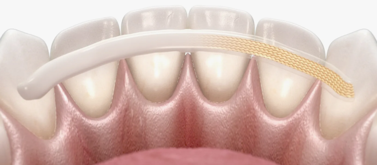 Шинирование зубов в стоматологической клинике Dental Clinic Dominanta ул. Чапаева 77