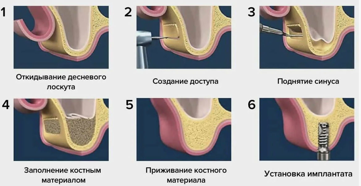 Стоматология Dominanta г. Краснодар ул. Чапаева 77 Синуслифтинг открытый (не включая остеопластический
                        материал)
