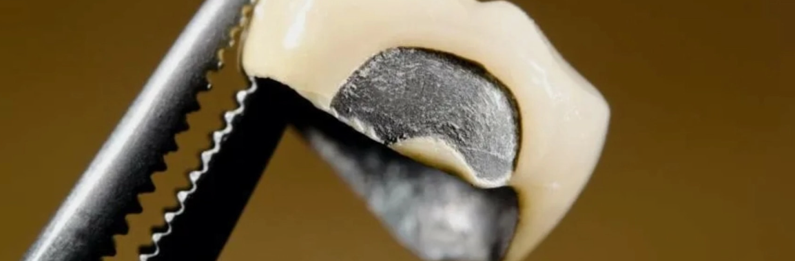 Стоматология Dominanta г. Краснодар Снятие коронки в стоматологии ул.Чапаева 77 Dental Clinic